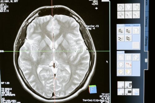 scan of traumatic brain injury