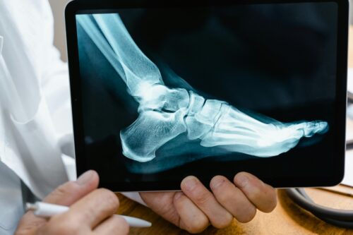 A person holds a tablet displaying an X-ray image of a human foot and ankle, showing clear bone structure. A hand holding a stylus is visible in the lower left corner of the image.